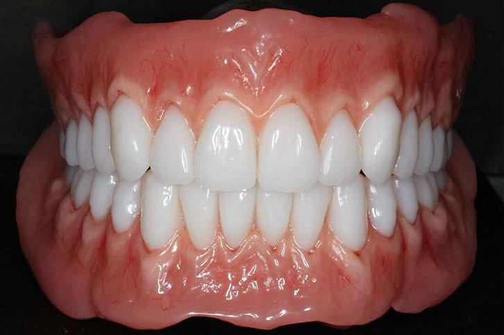 Rotorua Dentures Gum Tinting