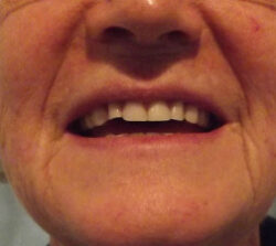Cheryl before and after Rotorua Dentures