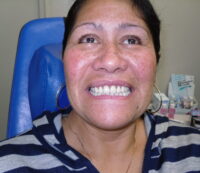 Jose Jefford after Rotorua Dentures