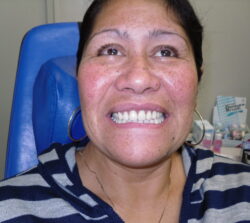 Jose Jefford after Rotorua Dentures